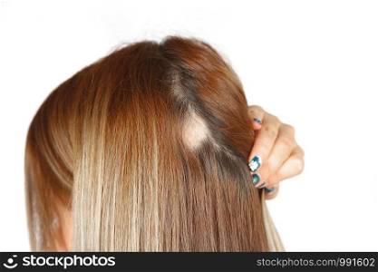 30 year old Caucasian woman with spot alopecia, bald spot on her head