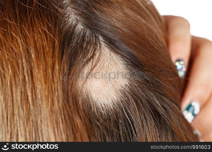 30 year old Caucasian woman with spot alopecia, bald spot on her head