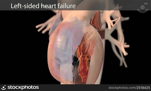 3D Animated right-sided heart failure - beating heart 3D illustration. 3D Animated right-sided heart failure - beating heart