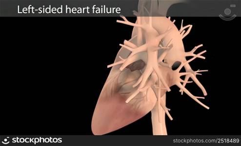 3D Animated right-sided heart failure - beating heart 3D illustration. 3D Animated right-sided heart failure - beating heart