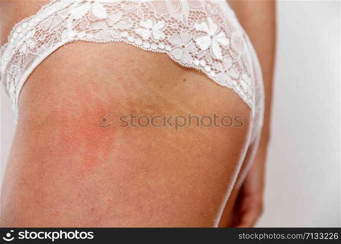 A 22 year old woman in white panties is standing with her back to the camera on a light gray isolated background. concept for medicine and cosmetology.