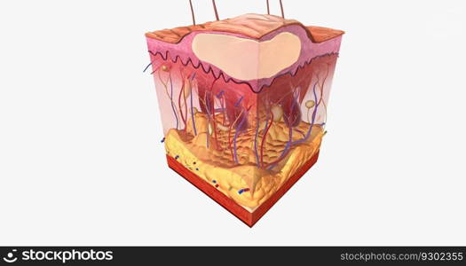 A blister is a fluid-filled raised area on the skin caused by too much friction in one location. 3D rendering. A blister is a fluid-filled raised area on the skin caused by too much friction in one location.