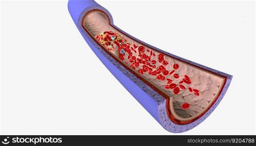 A blood clot in a vein, or venous thrombus, is the clumping of blood in vessels that bring blood back to the heart. 3D rendering. A blood clot in a vein, or venous thrombus, is the clumping of blood in vessels that bring blood back to the heart.