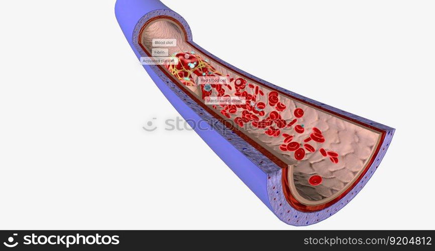 A blood clot in a vein, or venous thrombus, is the clumping of blood in vessels that bring blood back to the heart. 3D rendering. A blood clot in a vein, or venous thrombus, is the clumping of blood in vessels that bring blood back to the heart.