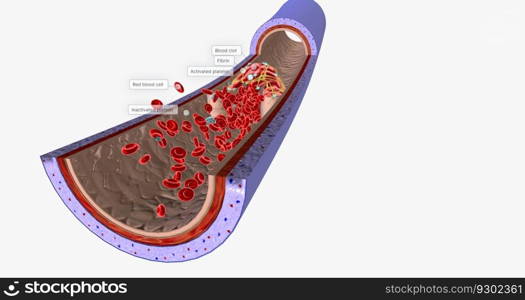 A blood clot in a vein, or venous thrombus, is the clumping of blood in vessels that bring blood back to the heart. 3D rendering. A blood clot in a vein, or venous thrombus, is the clumping of blood in vessels that bring blood back to the heart.