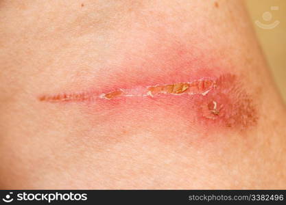 A burn scar that is partly healed