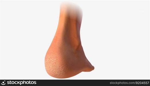 A callus is an area of thickened, hardened skin that develops as a result of frequent rubbing or repetitive motion.3D rendering. A callus is an area of thickened, hardened skin that develops as a result of frequent rubbing or repetitive motion.