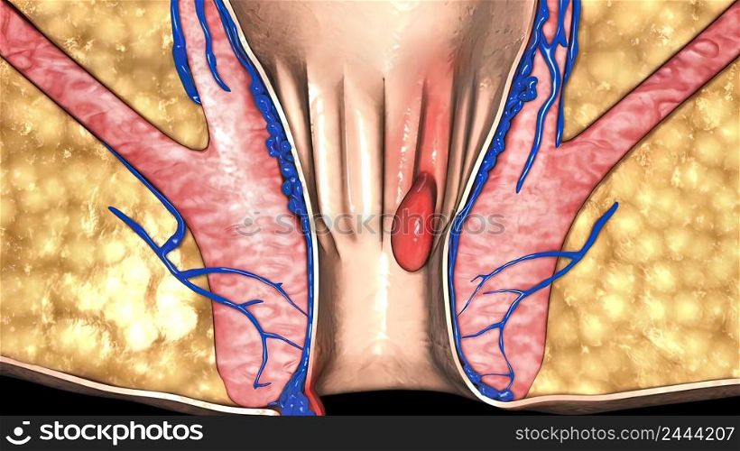A first degree internal hemorrhoid bulges into the anal canal during bowel movements. 3d illustration. A first degree internal hemorrhoid bulges into the anal canal during bowel movements.