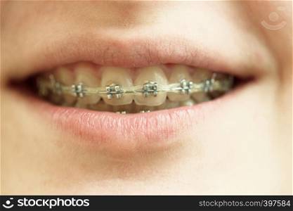 a girl with braces close-up