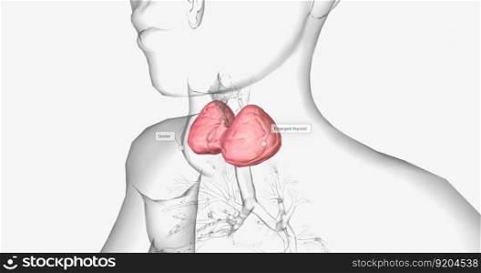 A goiter is a swollen, rounded lump in the throat caused by the abnormal enlargement of the thyroid gland. 3D rendering. A goiter is a swollen, rounded lump in the throat caused by the abnormal enlargement of the thyroid gland.