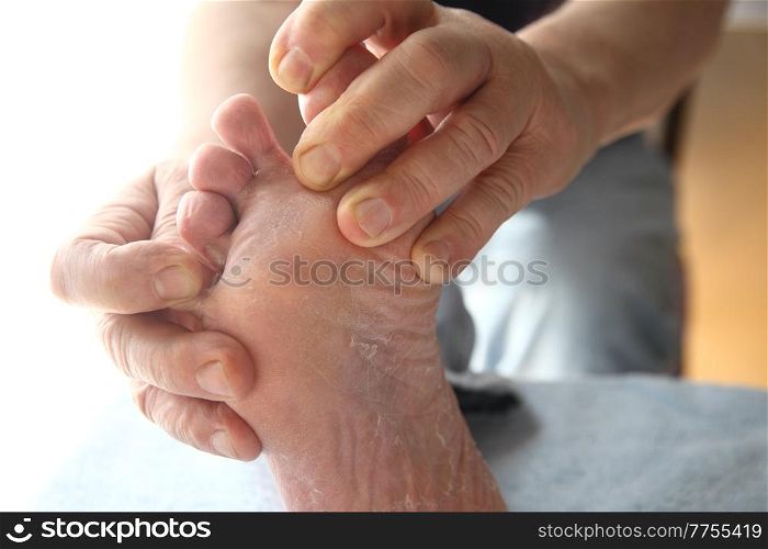 a man with dry skin on his foot and between his toes