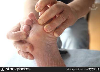 a man with dry skin on his foot and between his toes