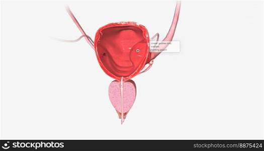 A ureterocele is a congenital defect of the ureter, the tube that carries urine from the kidney to the urinary bladder. 3D rendering. A ureterocele is a congenital defect of the ureter, the tube that carries urine from the kidney to the urinary bladder.