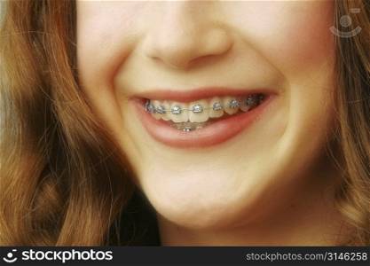 A womans smile with Braces.