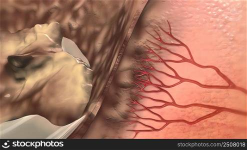A wound infection occurs when bacteria enters a break in the skin. The infection may involve just the skin, or affect deeper tissues or organs close to the wound. 3D illustration. of infected wound