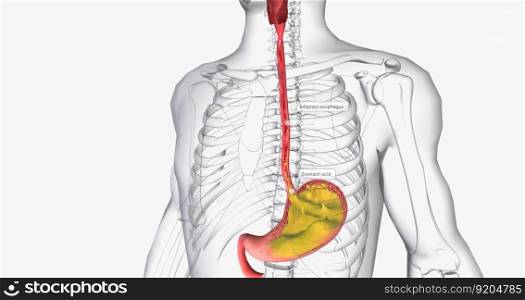 Acid reflux is caused by the involuntary release of stomach acid into the esophagus, throat, and mouth.3D rendering. Acid reflux is caused by the involuntary release of stomach acid into the esophagus, throat, and mouth.