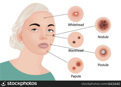 Acne types on a face vector illustration. Cosmetology skincare, skin treatment