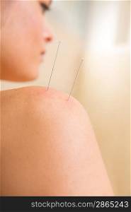 Acupuncture needle pricking on woman shoulder therapy closeup