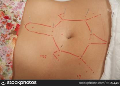 Acupuncture Needles in a Woman&rsquo;s Midsection