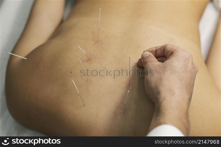 acupuncture process close up
