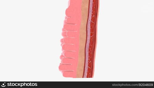 Adenocarcinoma of the esophagus results from abnormal cell mutations and growth in the esophageal lining, or mucosa. 3D rendering. Adenocarcinoma of the esophagus results from abnormal cell mutations and growth in the esophageal lining, or mucosa.