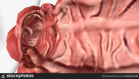 Adenomatous polyps are gland-like growths that develop on the mucous membrane lining the large intestine. 3D rendering. Adenomatous polyps are gland-like growths that develop on the mucous membrane lining the large intestine.
