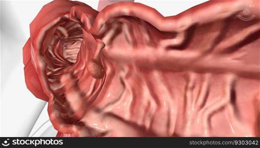 Adenomatous polyps are gland-like growths that develop on the mucous membrane lining the large intestine. 3D rendering. Adenomatous polyps are gland-like growths that develop on the mucous membrane lining the large intestine.