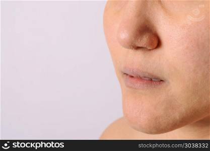 Allergic women have eczema dry nose and lips on winter season cl. Allergic women have eczema dry nose and lips on winter season closeup.