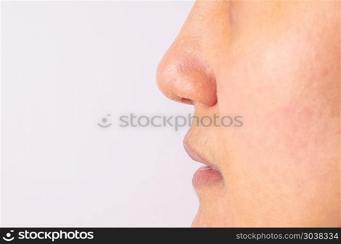 Allergic women have eczema dry nose and lips on winter season cl. Allergic women have eczema dry nose and lips on winter season closeup.