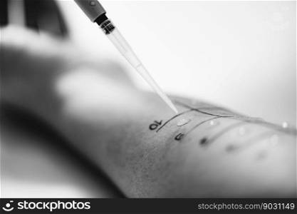 Allergy - Skin Prick Tests on a Woman&rsquo;s Arm. Allergy - Skin Prick Testing