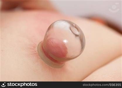 Alternative medicine health care. Fire cupping procedure, woman laying on chest, receiving vacuum cupping massage treatment, closeup of human back.. Human back, receiving vacuum cupping massage