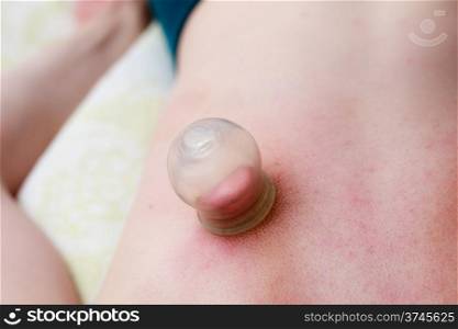 Alternative medicine health care. Fire cupping procedure, woman receiving vacuum cupping massage treatment, detail on female back.