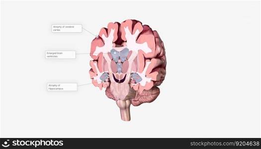 Alzheimer&rsquo;s Disease Brain Cross Section 3D rendering. Alzheimer&rsquo;s Disease Brain Cross Section
