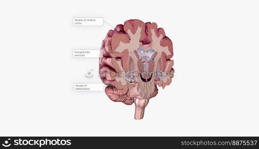 Alzheimer’s Disease Brain Cross Section 3D rendering. Alzheimer’s Disease Brain Cross Section