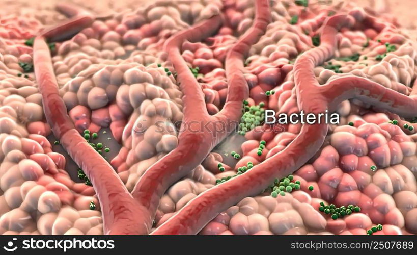 An abscess is a collection of pus that has built up within the tissue of the body. 3D illustration. Animatied of infected wound ,bacteria , pus, abscess