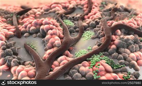 An abscess is a collection of pus that has built up within the tissue of the body. 3D illustration. Animatied of infected wound ,bacteria , pus, abscess