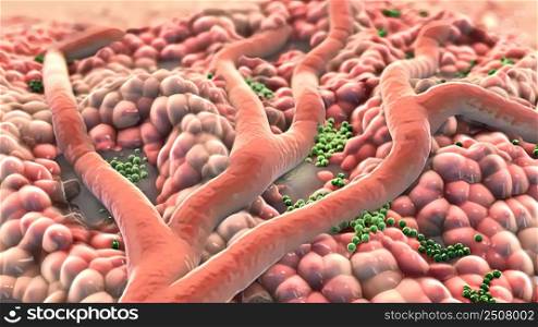 An abscess is a collection of pus that has built up within the tissue of the body. 3D illustration. Animatied of infected wound ,bacteria , pus, abscess