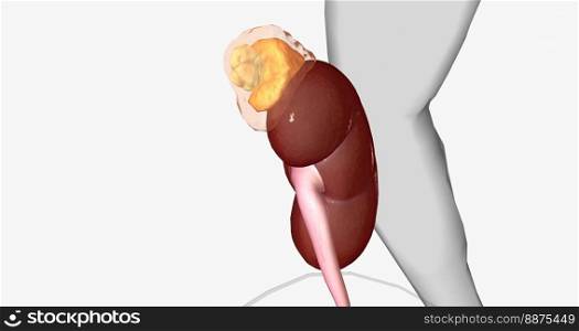 An adrenal incidentaloma is a solid mass in one or both adrenal glands. 3D rendering. An adrenal incidentaloma is a solid mass in one or both adrenal glands.