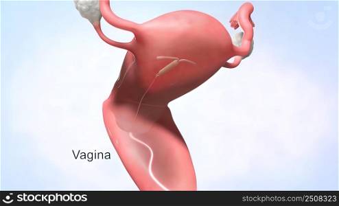 An IUD is a small device inserted into your uterus to prevent pregnancy. 3D illustration. birth control device (IUD)