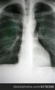 an x-ray image the heart and lungs of a person shows.