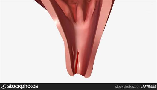 Anal fissure is a small tear in the lining of the anal mucosa. 3D rendering. Anal fissure is a small tear in the lining of the anal mucosa.