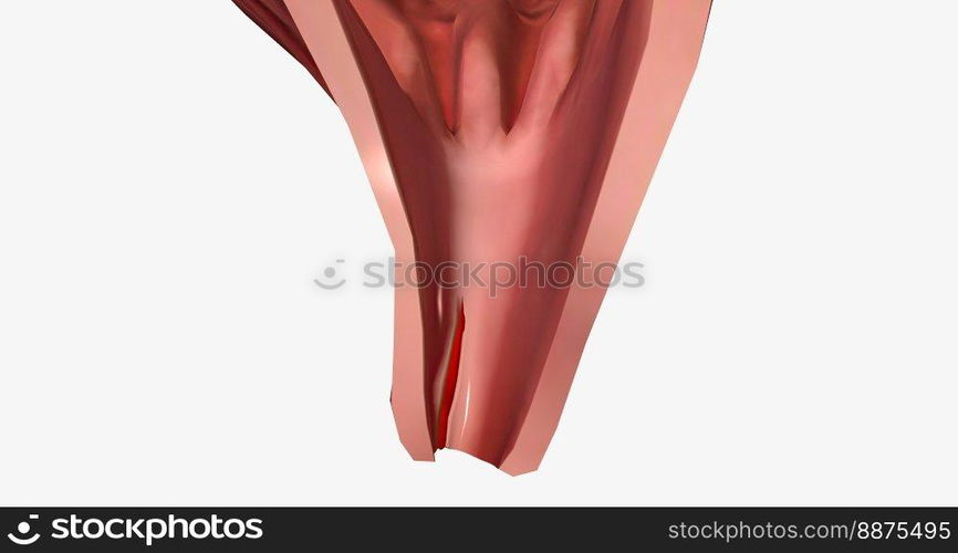 Anal fissure is a small tear in the lining of the anal mucosa. 3D rendering. Anal fissure is a small tear in the lining of the anal mucosa.