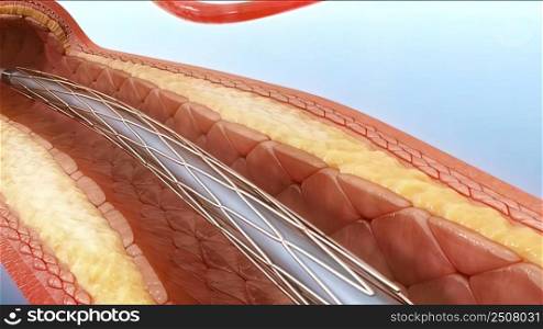 Angioplasty and Vascular Stenting, inserting a stent into vascular access 3D illustration. Angioplasty and Vascular Stenting