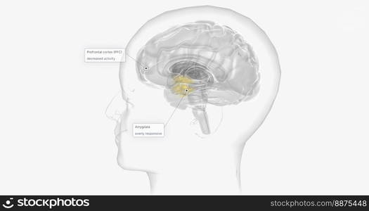 Anxiety disorder is a brain disorder that causes overwhelming anxious feelings that affect daily activities. 3D rendering. Anxiety disorder is a brain disorder that causes overwhelming anxious feelings that affect daily activities.