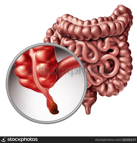 Appendicitis and appendix inflammation disease concept as a close up of human intestine anatomy as a 3D illustration.