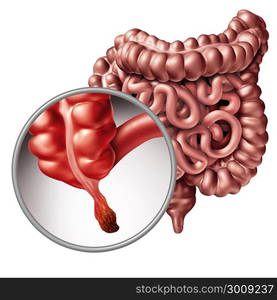 Appendicitis and appendix inflammation disease concept as a close up of human intestine anatomy as a 3D illustration.