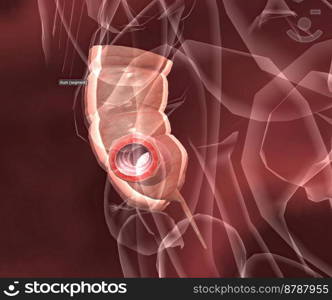 Appendicitis is inflammation of the appendix, a finger-shaped sac protruding from your colon on the lower right side of your abdomen. Appendicitis causes pain in the lower right abdomen. 3d illustration. Appendicitis is a painful swelling of the appendix.