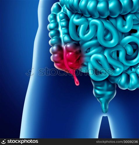 Appendix pain and appendicitis inflammation disease concept as a close up of human intestine anatomy as a 3D illustration.