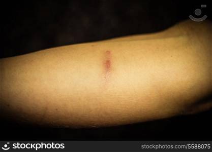 Arm with scar