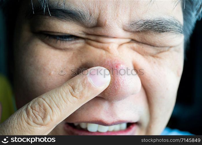 Asian guy taking index finger to large pimple and blackhead pimples and acne scars on him nose
